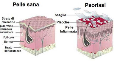 Psoriasi: sabato 29 la sia giornata mondiale