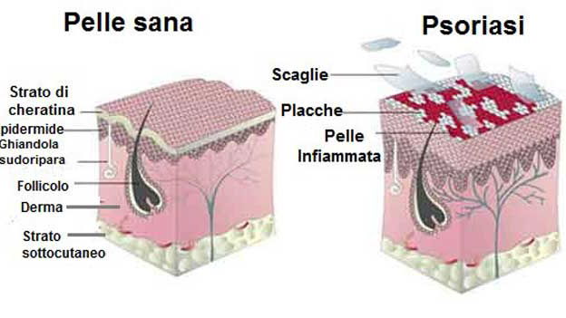 Psoriasi: sabato 29 la sia giornata mondiale