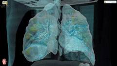 Una nuova prospettiva: la realtà virtuale mostra come il Covid-19 danneggia i polmoni