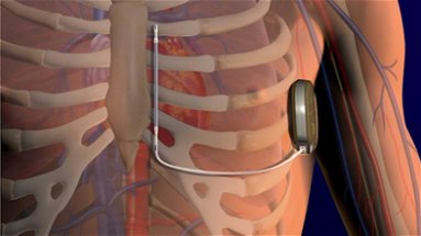 La Cardiologia del “Giannettasio” continua a macinare record: impiantato il primo defibrillatore sottocutaneo