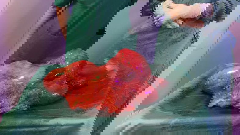 In Calabria un grande successo medico: asportato un tumore di 7,5 Kg