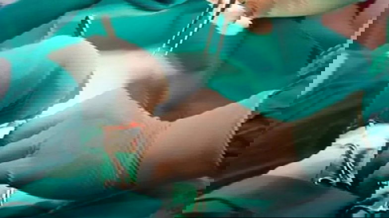 Annunziata, eseguiti due espianti multiorgano ed effettuati due trapianti di rene
